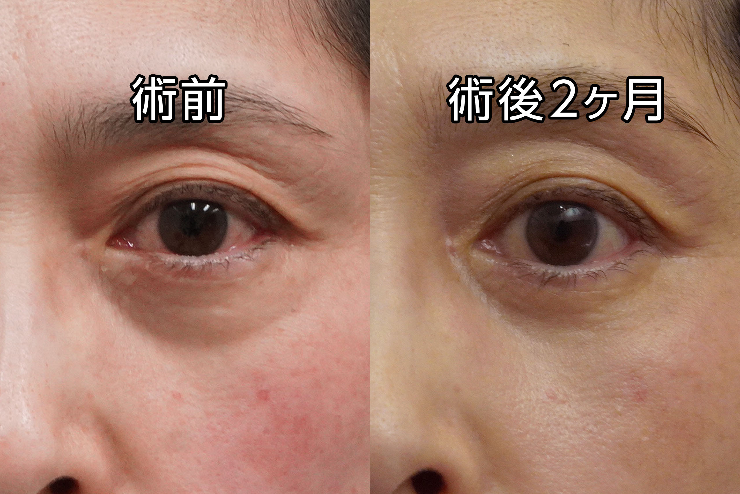 ★490　【他院修正】57歳女性　経結膜脱脂術＋眼窩脂肪注入