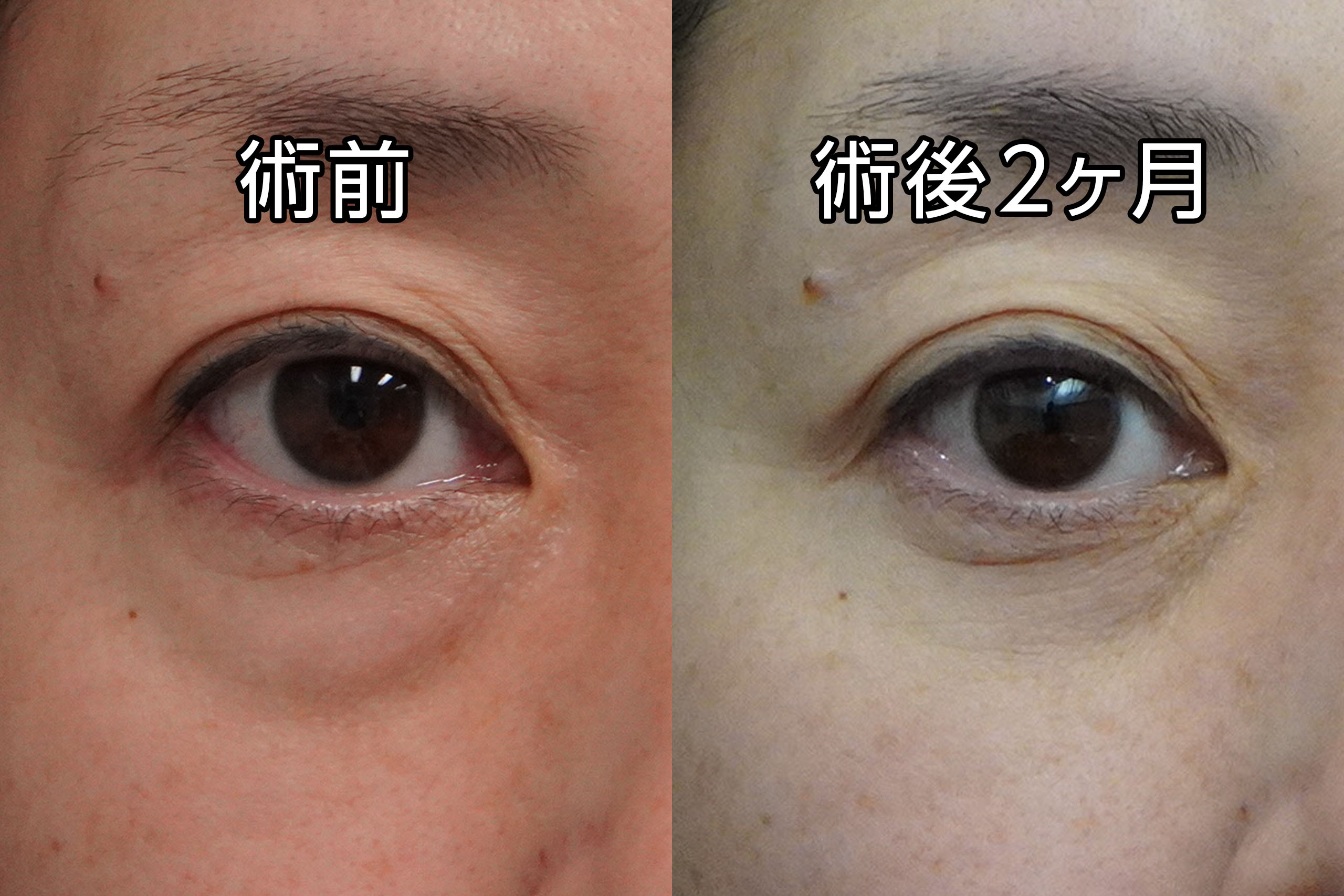 ★494　48歳女性　経結膜脱脂術＋眼窩脂肪注入＋ボトックス注射（ボトックスビスタ 眉間）