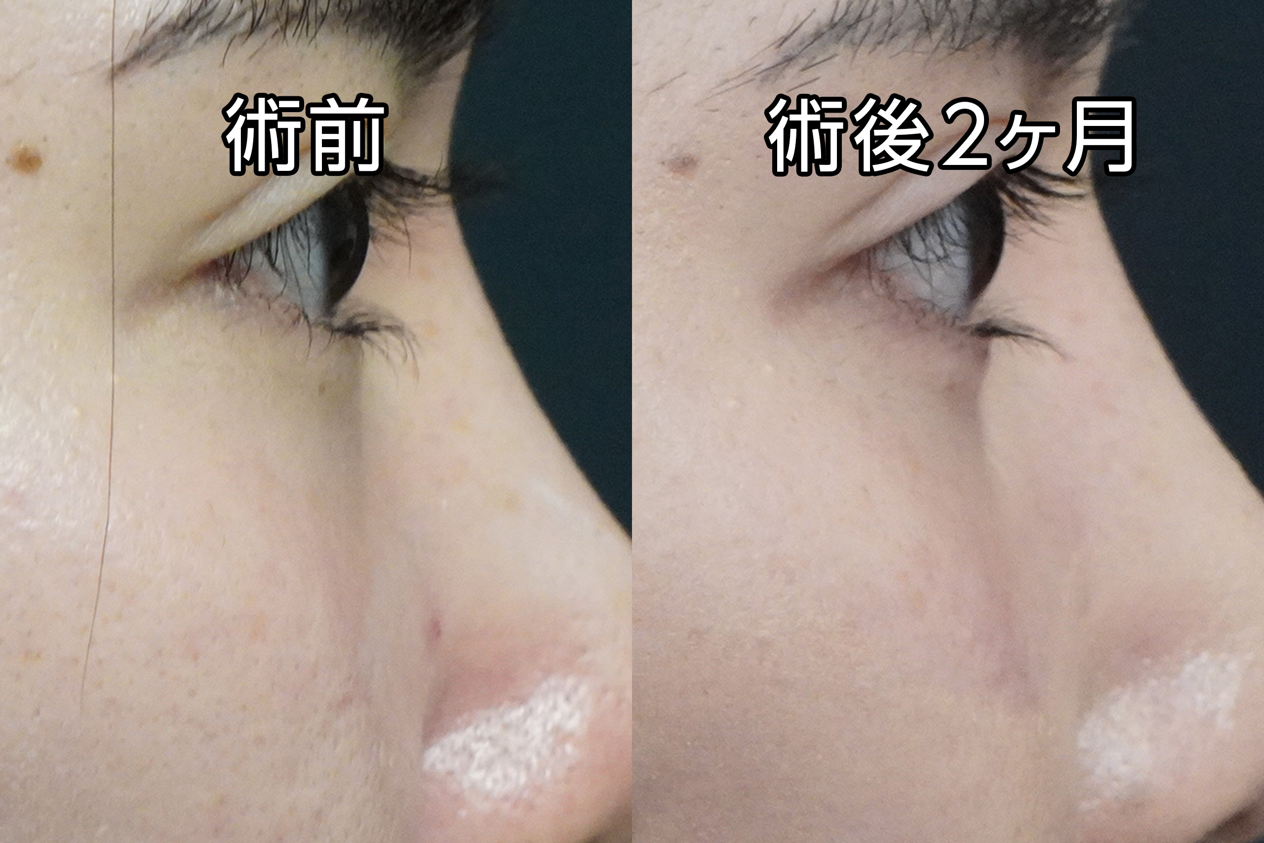 ★498　28歳女性　経結膜脱脂術＋マイクロCRF注入（目の下、中顔面）