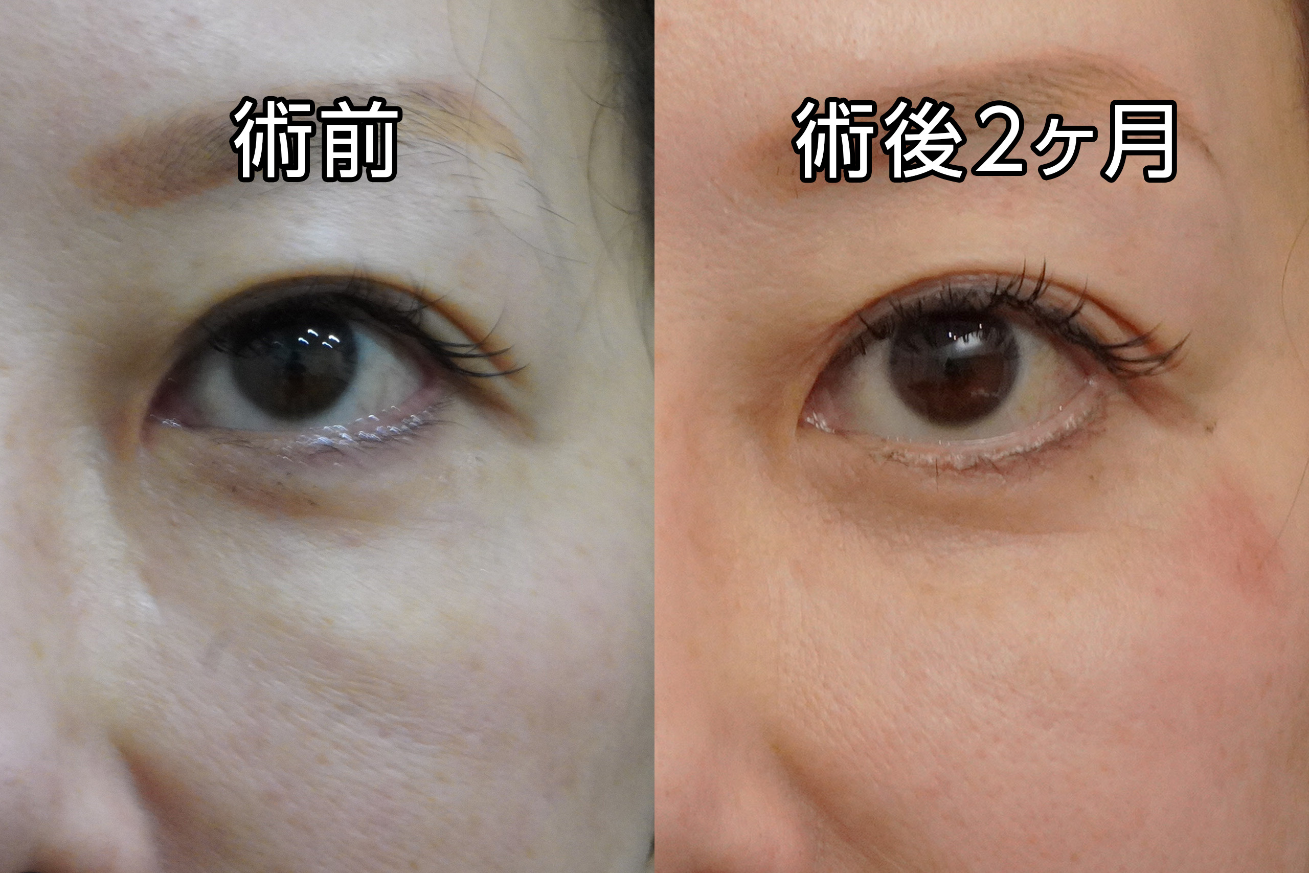 ★503　【ハムラ法 他院修正 】52歳女性　ヒアルロン酸溶解からの経結膜脱脂術＋眼窩脂肪注入