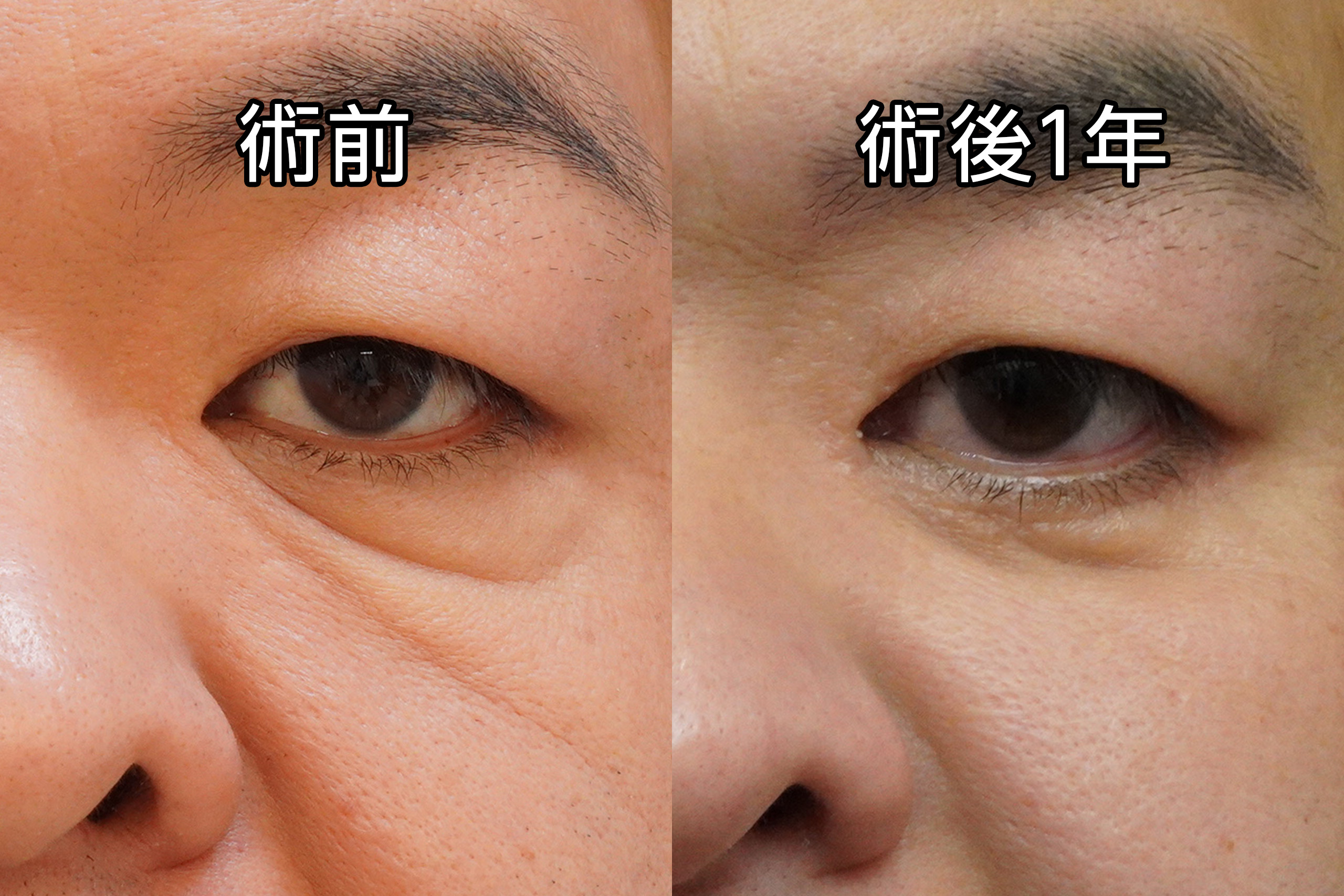 ★419−2【術後1年】　47歳男性 経結膜脱脂術+MicroCRF+皮膚切開たるみ取り【人生変わった→もう手術したこと忘れた】