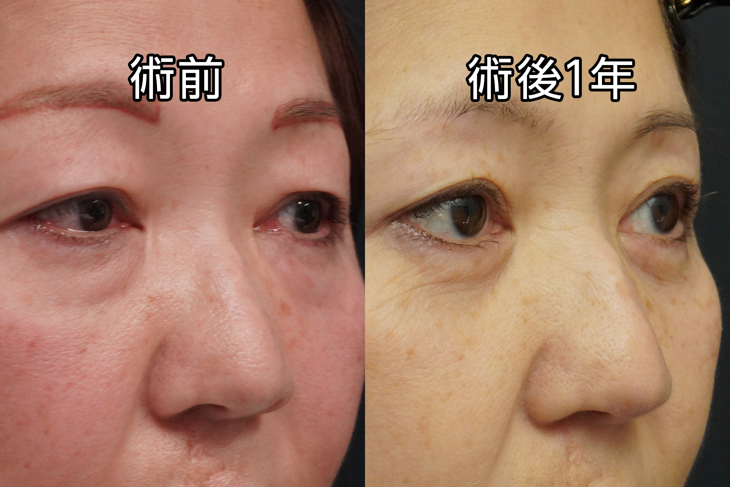 ★500　56歳女性　経結膜脱脂術＋マイクロCRF注入（目の下、中顔面、ほうれい線、オトガイ、マリオネットライン）＋眉下切開