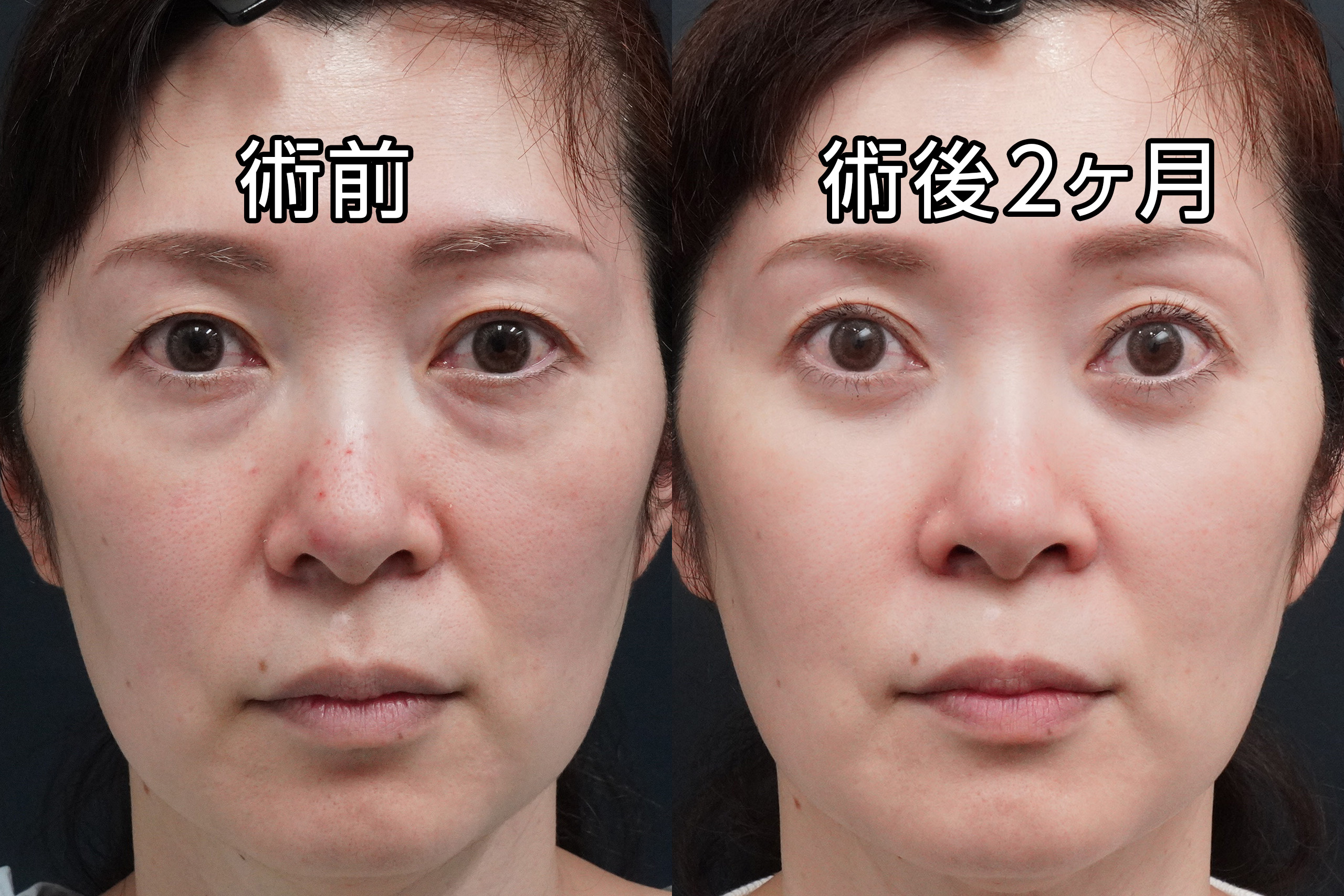 ★504　【全顔モニター】52歳女性　経結膜脱脂術＋マイクロCRF注入＋二重埋没法プレミアムクイック
