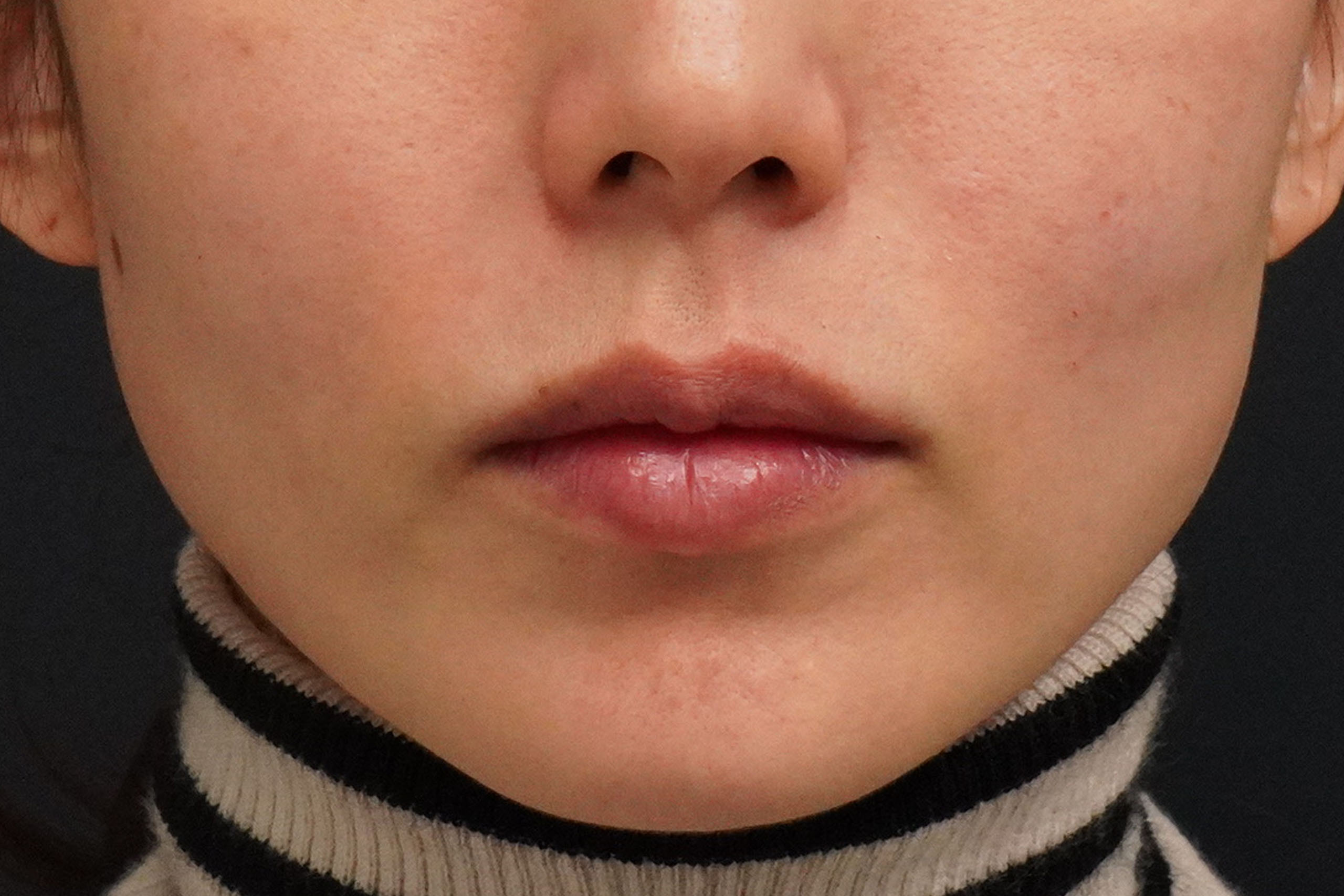 44歳女性　中顔面のヒアルロン酸注入＋エラボトックス（小顔注射）