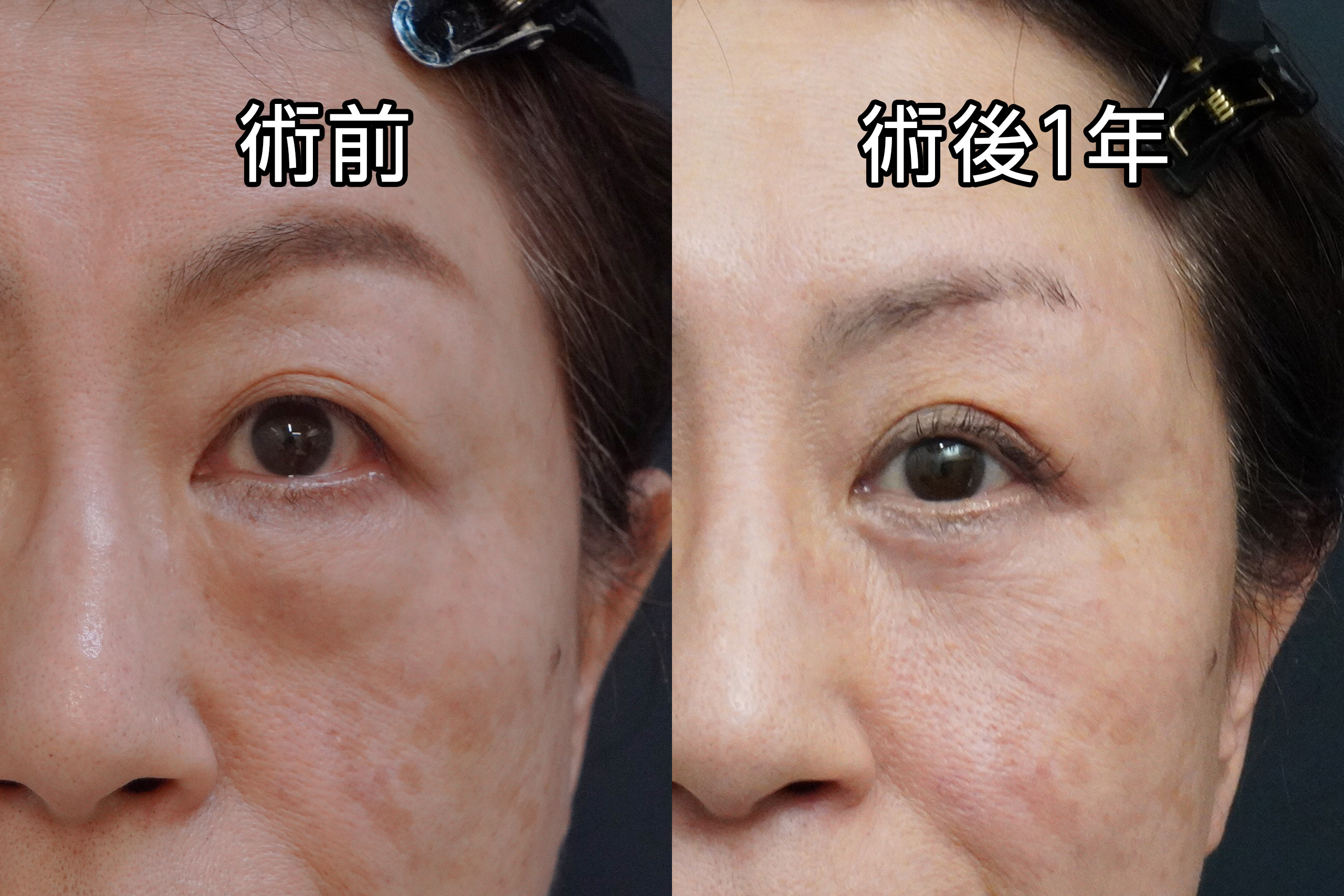 ☆34-2　★444-2　【1年後】61歳女性　経結膜脱脂術+マイクロCRF 下まぶた切開たるみ取り+眉下切開