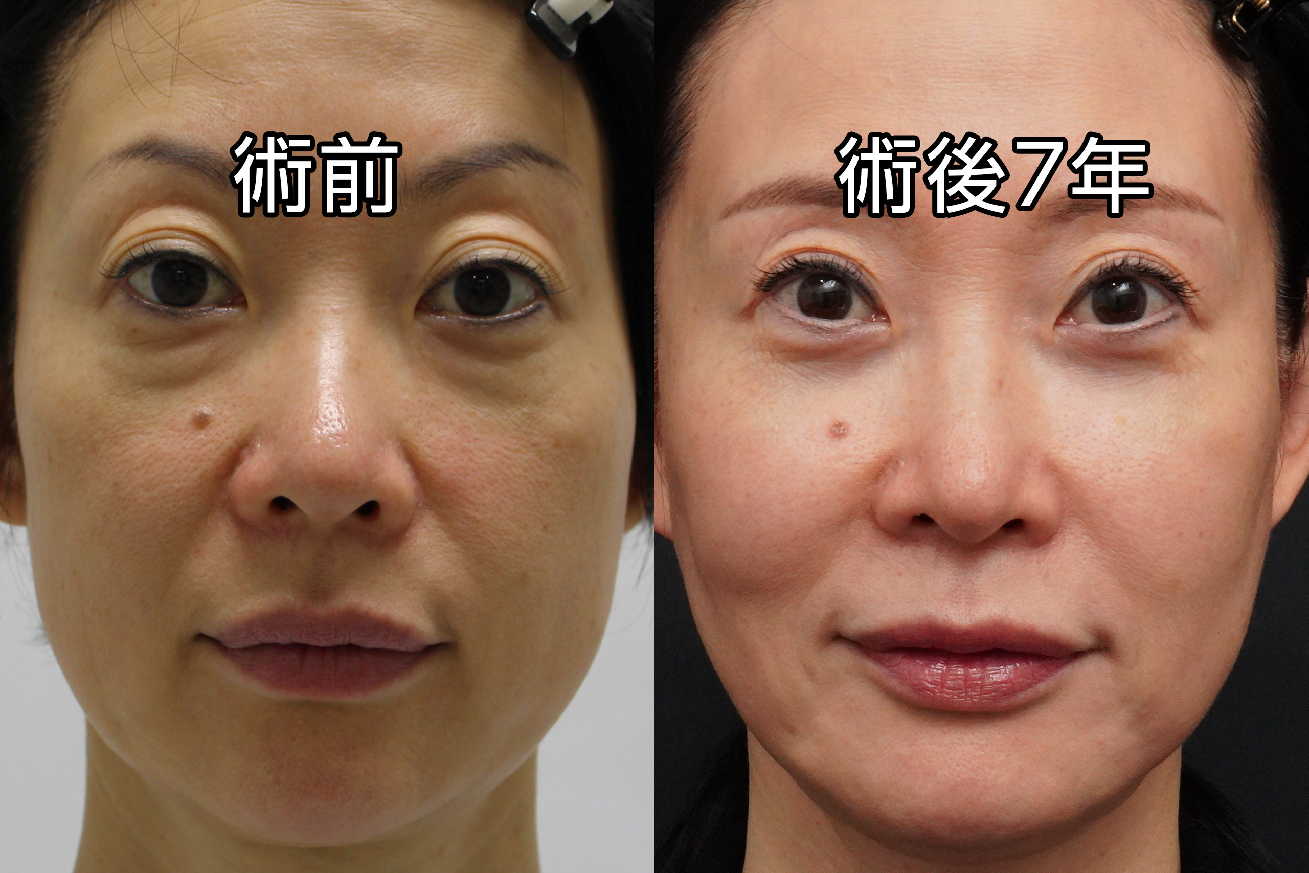 【術後7年！驚愕の若返り！】★173-3　48歳女性　経結膜脱脂術+マイクロCRF（目の下・中顔面）