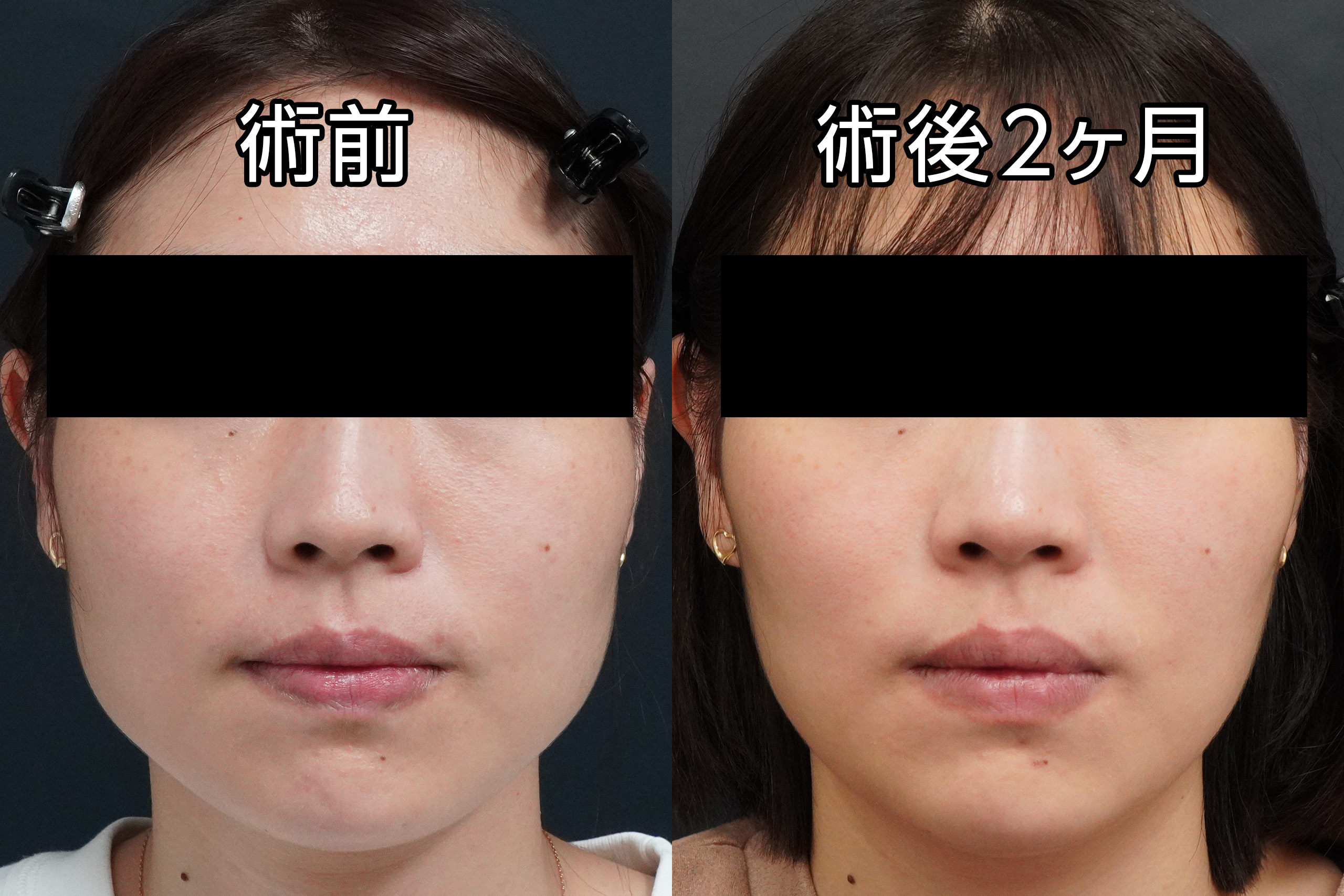 【劇的変化！！】37歳女性　エラボトックス（小顔注射）ボトックスビスタ100単位