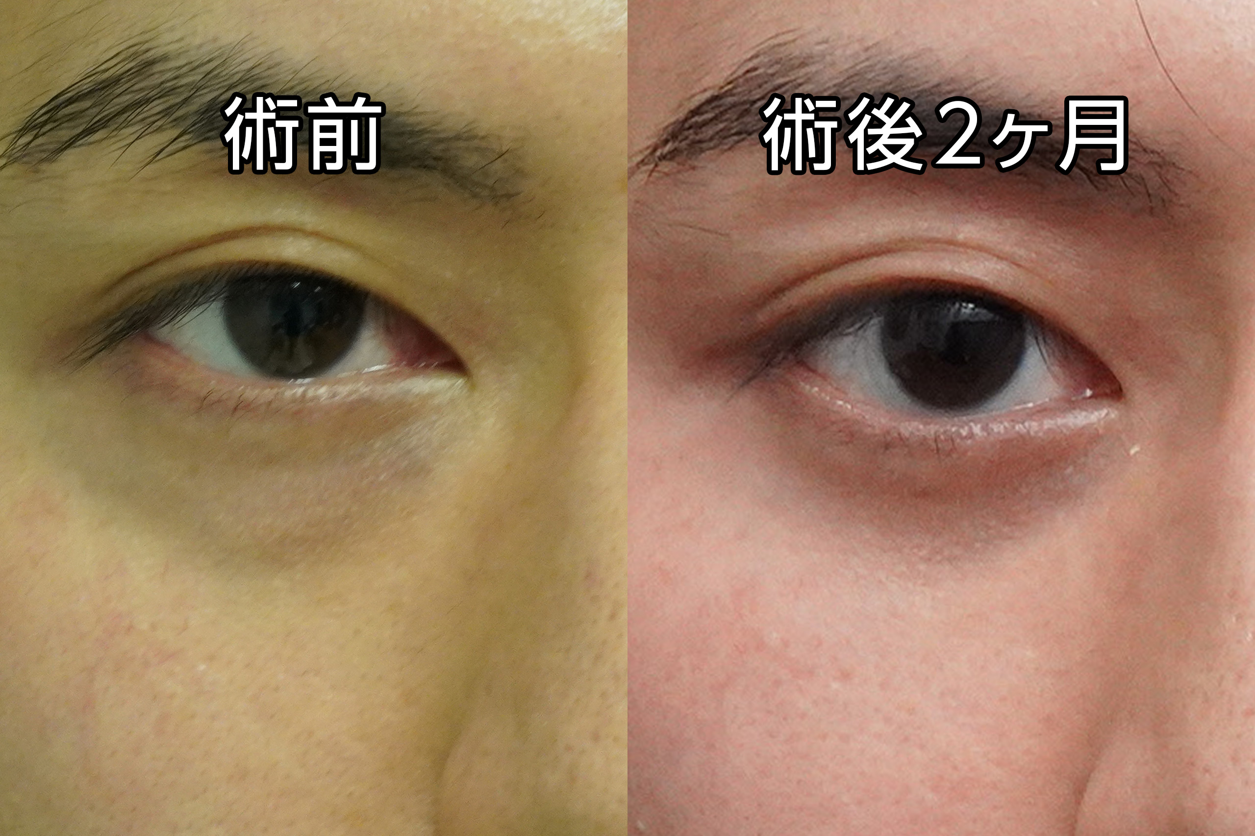 ★517　28歳男性　経結膜脱脂術＋眼窩脂肪注入