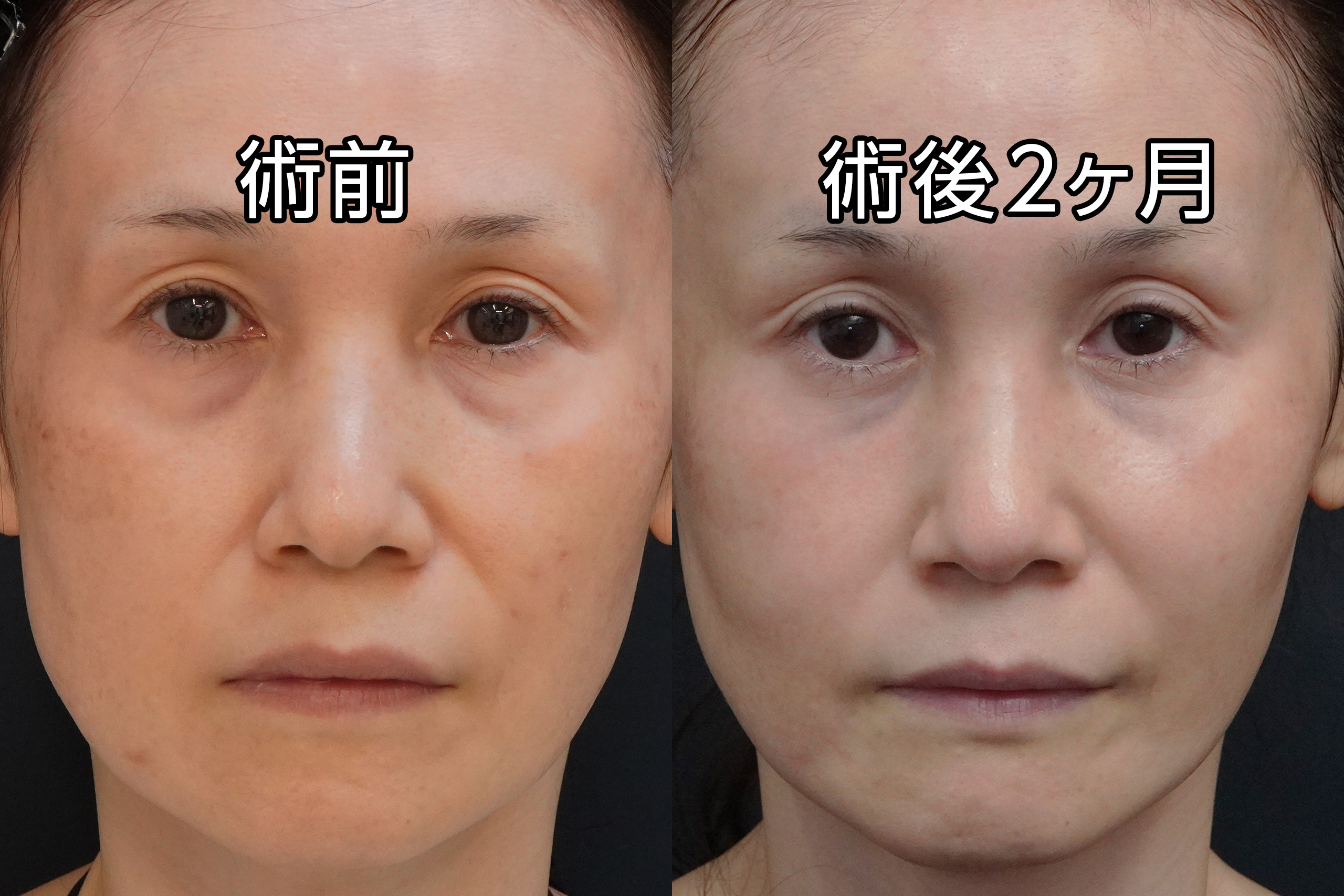 ★518　【全顔モニター】49歳女性　経結膜脱脂術＋マイクロCRF注入（目の下、中顔面、ほうれい線、オトガイ、マリオネットライン）