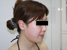 シンシア～Sincerely Yours　銀座の美容外科・美容皮膚科-ほほ アゴ　脂肪吸引　効果　写真