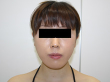 シンシア～Sincerely Yours　銀座の美容外科・美容皮膚科-ほほ アゴ　脂肪吸引　効果　写真