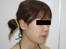 シンシア～Sincerely Yours　銀座の美容外科・美容皮膚科-ほほ アゴ　脂肪吸引　効果　写真