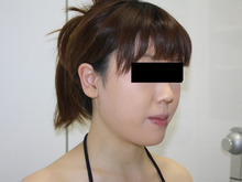 シンシア～Sincerely Yours　銀座の美容外科・美容皮膚科-ほほ アゴ　脂肪吸引　効果　写真