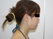 シンシア～Sincerely Yours　銀座の美容外科・美容皮膚科-ほほ アゴ　脂肪吸引　効果　写真