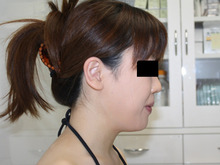 シンシア～Sincerely Yours　銀座の美容外科・美容皮膚科-ほほ アゴ　脂肪吸引　効果　写真