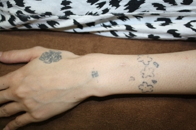 シンシア～Sincerely Yours　銀座の美容外科・美容皮膚科-Tattoo 入れ墨 刺青 レーザー　除去　