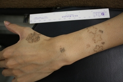 クリとリス改造刺青 自分で彫った入れ墨（Tattoo）をレーザー除去 - シンシア総院長ブログ～Sincerely Yours 銀座の美容外科・美容皮膚科