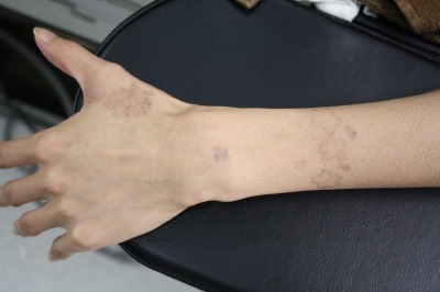 シンシア～Sincerely Yours　銀座の美容外科・美容皮膚科-Tattoo 入れ墨 刺青 レーザー　除去　