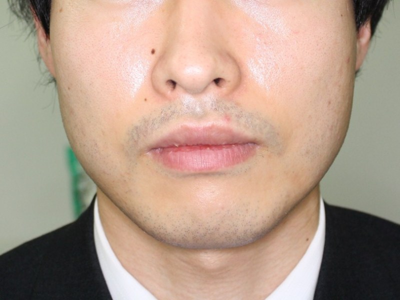 1 男の口唇縮小術 術前 1ヶ月 3 シンシア総院長ブログ Sincerely Yours 銀座の美容外科 美容皮膚科