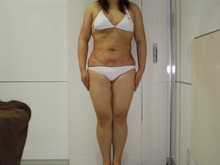 シンシア～Sincerely Yours　銀座の美容外科・美容皮膚科-大量脂肪吸引　名医　口コミ　画像