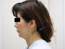 シンシア～Sincerely Yours　銀座の美容外科・美容皮膚科-フェイスリフト　口コミ　名医　安い