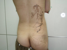 シンシア～Sincerely Yours　銀座の美容外科・美容皮膚科-Tattoo 入れ墨 刺青 レーザー　痛み