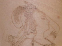シンシア～Sincerely Yours　銀座の美容外科・美容皮膚科-Tattoo 入れ墨 刺青 レーザー　評判　