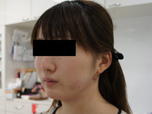 シンシア～Sincerely Yours　銀座の美容外科・美容皮膚科-顔やせ 脂肪吸引　頬　アゴ　写真