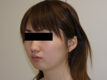 シンシア～Sincerely Yours　銀座の美容外科・美容皮膚科-顔やせ 脂肪吸引　頬　アゴ　安い　