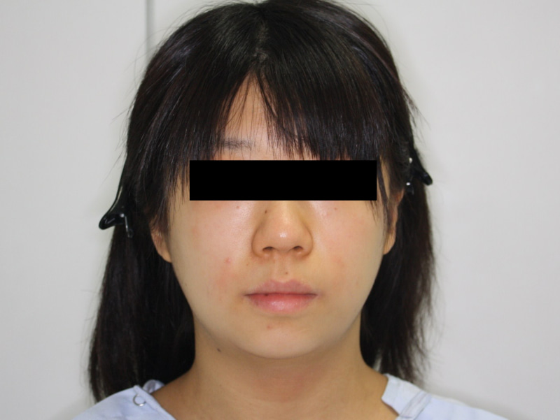 シンシア～Sincerely Yours　銀座の美容外科・美容皮膚科-ほほ アゴ　脂肪吸引　効果　写真