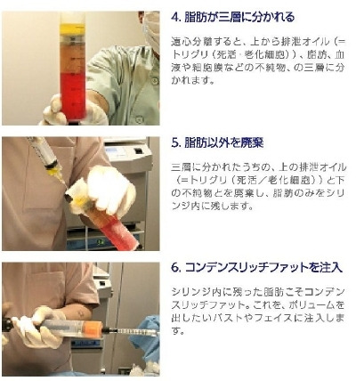 シンシア～Sincerely Yours　銀座の美容外科・美容皮膚科-コンデンスリッチファット　CRF　豊胸
