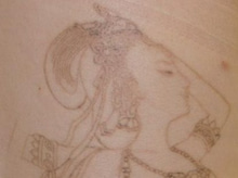 シンシア～Sincerely Yours　銀座の美容外科・美容皮膚科-Tattoo 入れ墨 刺青 レーザー　評判　