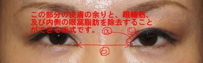 シンシア～Sincerely Yours　銀座の美容外科・美容皮膚科-目頭切開　平行型二重 傷跡 傷 東京 口コミ