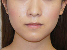 シンシア～Sincerely Yours　銀座の美容外科・美容皮膚科-小顔　エラ　注射　ボトックス BOTOX　ボツリヌス