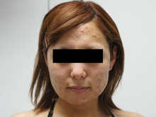 シンシア～Sincerely Yours　銀座の美容外科・美容皮膚科-ベイザー　頬 アゴ　東京 ロアキュタン　口コミ