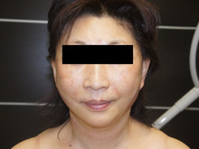 シンシア～Sincerely Yours　銀座の美容外科・美容皮膚科-フェイスリフト 東京 腫れ 内出血 効果 口コミ 名医