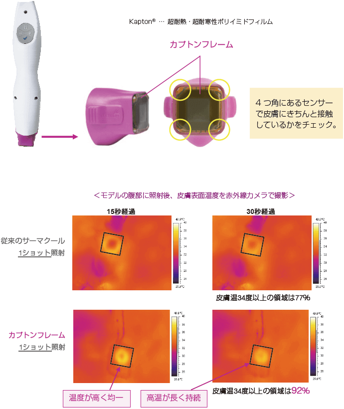 サーマクールFLXでお顔のたるみを改善| 美容外科のシンシア サーマクールFLXでお顔のたるみを改善| 美容外科のシンシア