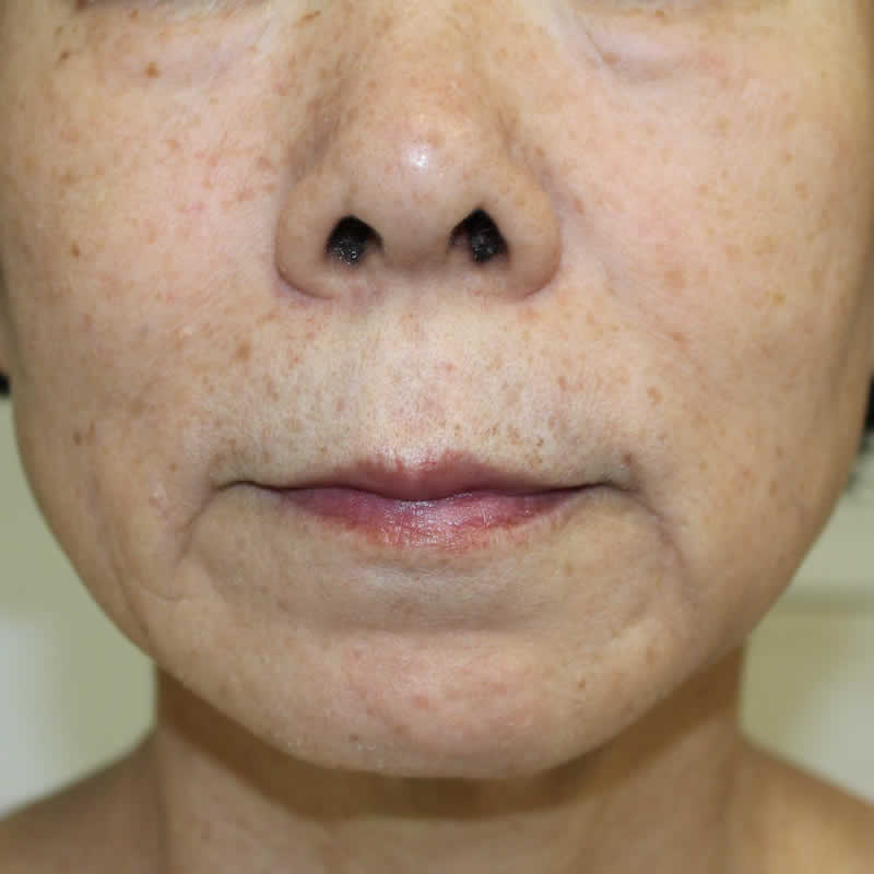 顔に多発する血ボクロ“老人性血管腫”レーザー　術後2か月