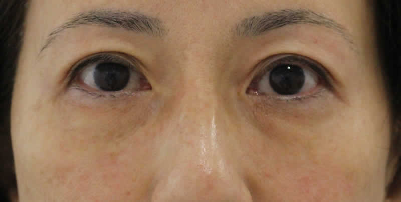 経結膜脱脂術+眼窩脂肪注入　術前