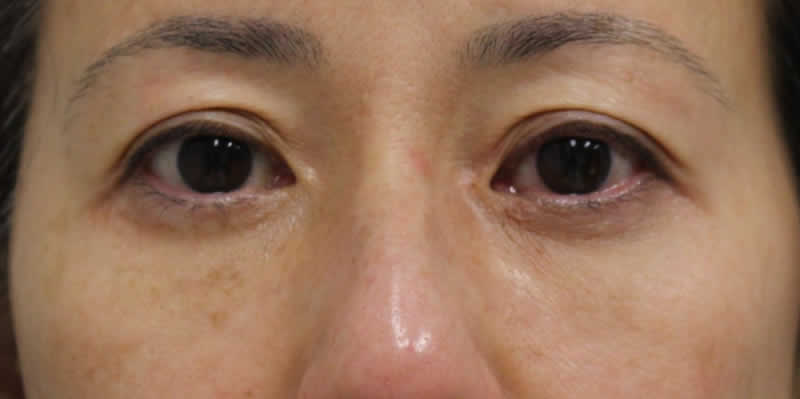 経結膜脱脂術+眼窩脂肪注入　術後2か月