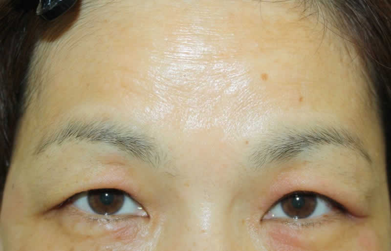 上まぶたのたるみ取り 眉下切開術 二重ライン切開術 コスメディカルクリニックシンシア 上まぶたのたるみ取り 眉下切開術 二重ライン切開術 コスメディカルクリニックシンシア
