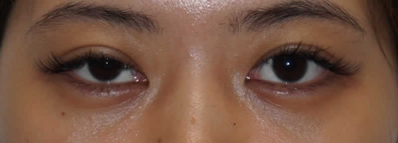 右目だけの眼瞼下垂手術　腱膜固定術　術前