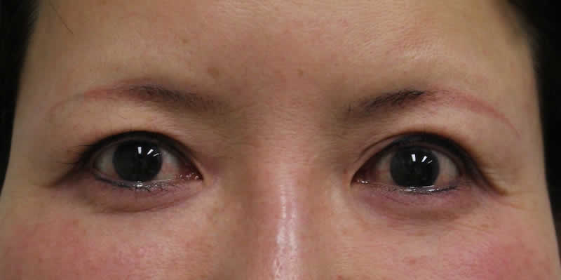 左目眼瞼下垂手術（皮膚切開+腱膜固定術）　術後5年