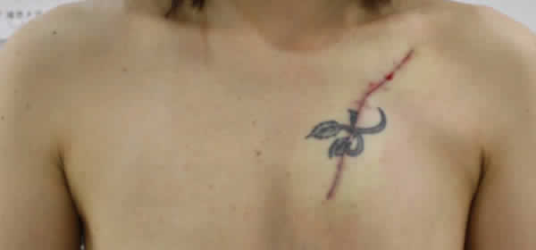 胸の大きなバラの入れ墨・刺青（分割切除）　第1回　術後