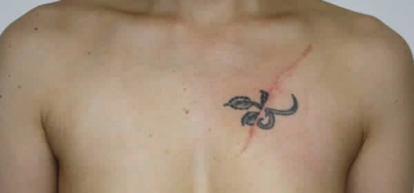 胸の大きなバラの入れ墨・刺青（分割切除）　第1回 術後 6か月