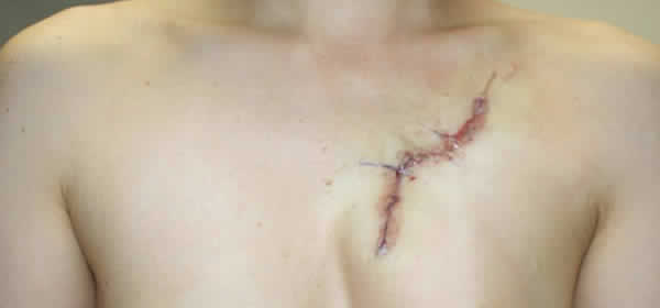 胸の大きなバラの入れ墨・刺青（分割切除）　第2回 術後直後