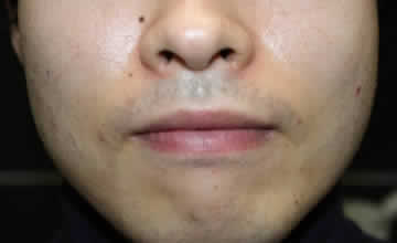 男の口唇縮小術　術後1週間