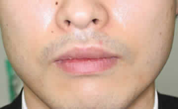 男の口唇縮小術　術後1か月