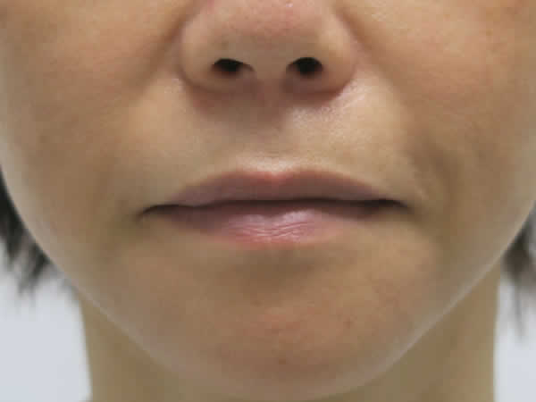上唇のリフト（BOCA）一か月　術前