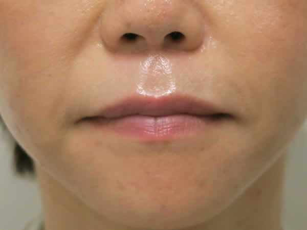 上唇のリフト（BOCA）一か月　術後1か月